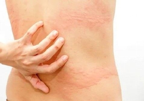 Берут ли в армию с дерматитом? Медицинские показания и ограничения