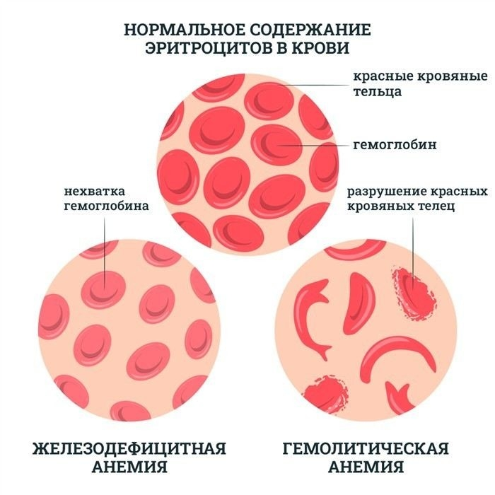 Категории годности при анемии