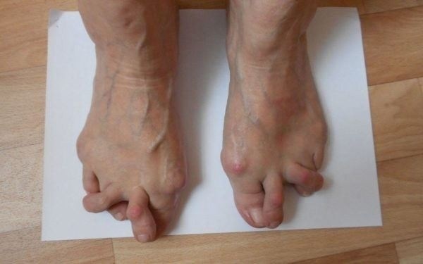 Как артрит влияет на призыв и что проверяется на дополнительном обследовании?