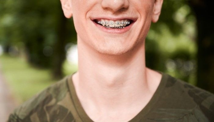 Влияние брекетов на здоровье: Может ли это стать основанием для отсрочки?