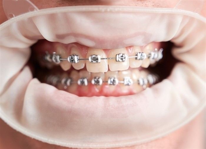 Как наличие брекетов влияет на призыв в армию?