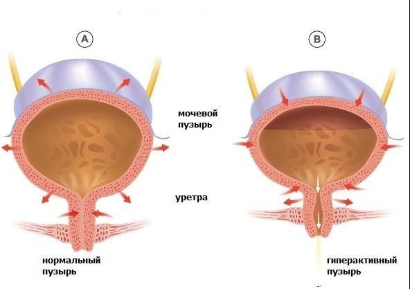 Как предотвратить ночной энурез у ребенка?