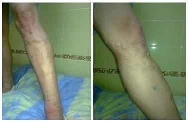 Сколько стоит флебэктомия и от чего зависит цена операции?