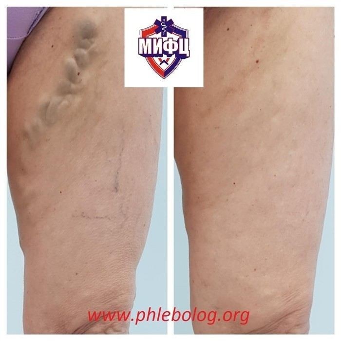 Часто задаваемые вопросы пациентов о флебэктомии