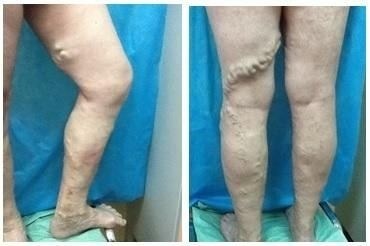 Как флебэктомию делали раньше и чем она отличается от современных методов?