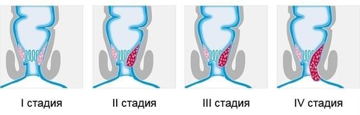Виды геморроя и их влияние на военную пригодность