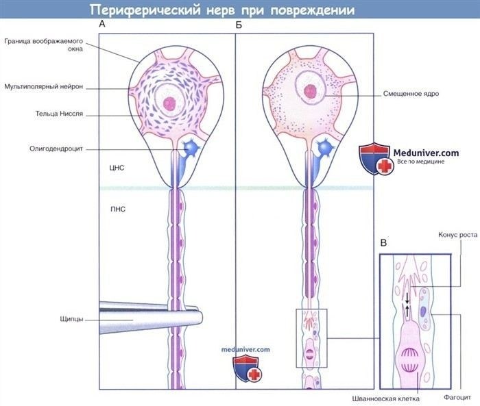 Дегенерация и регенерация периферического нерва: ключевые процессы