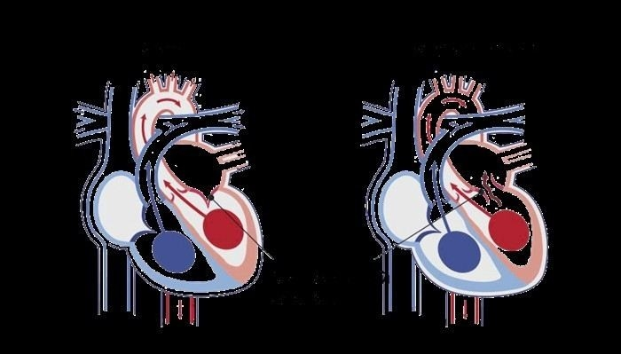 Какие рекомендации дает Минобороны для призывников с регургитацией?
