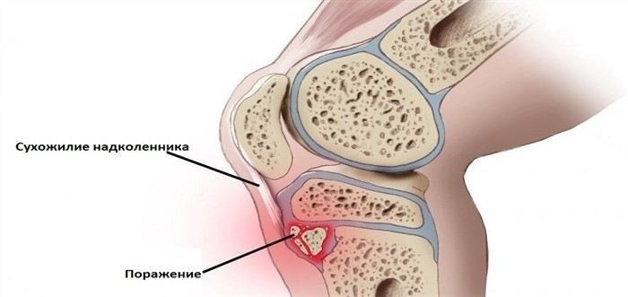 Ключевые симптомы болезни Шляттера и когда обращаться к врачу