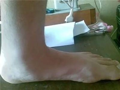 Какое обследование нужно пройти, чтобы избежать призыва с плоскостопием