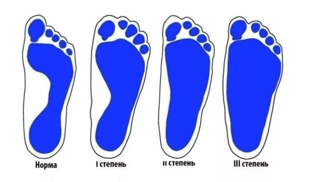 Как диагностируется плоскостопие и кто проводит обследование?