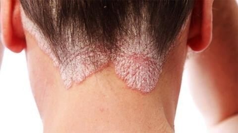 Что делать призывнику с псориазом волосистой части головы?