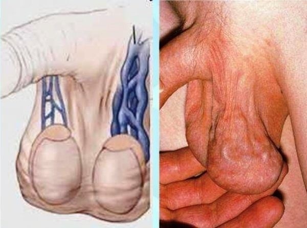 Какая категория годности к армии назначается при варикоцелле?