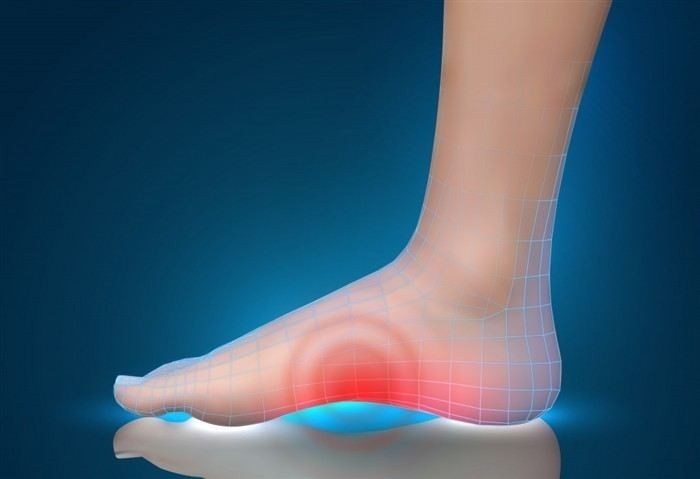 Какие виды плоскостопия существуют и чем они отличаются?