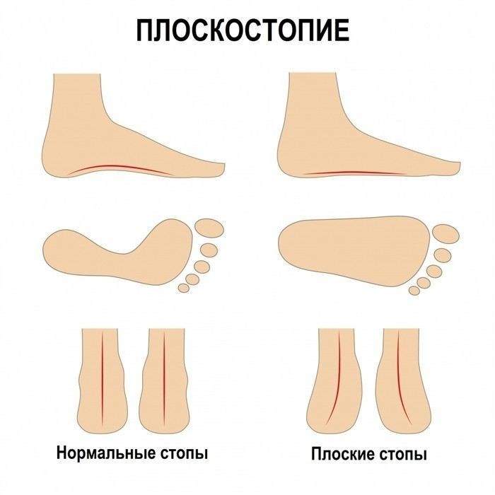 Плоскостопие у детей: когда и почему нужно обращаться к врачу?